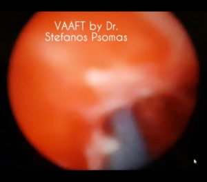 Video-Assisted Anal Fistula Treatment (VAAFT) for Complex Anal Fistula / Ενδοσκοπική μέθοδος αντιμετώπισης συριγγίων (VAAFT)