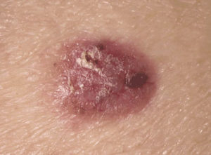 Βασικοκυτταρικό καρκίνωμα δέρματος προσώπου (Basal Cell Carcinoma)