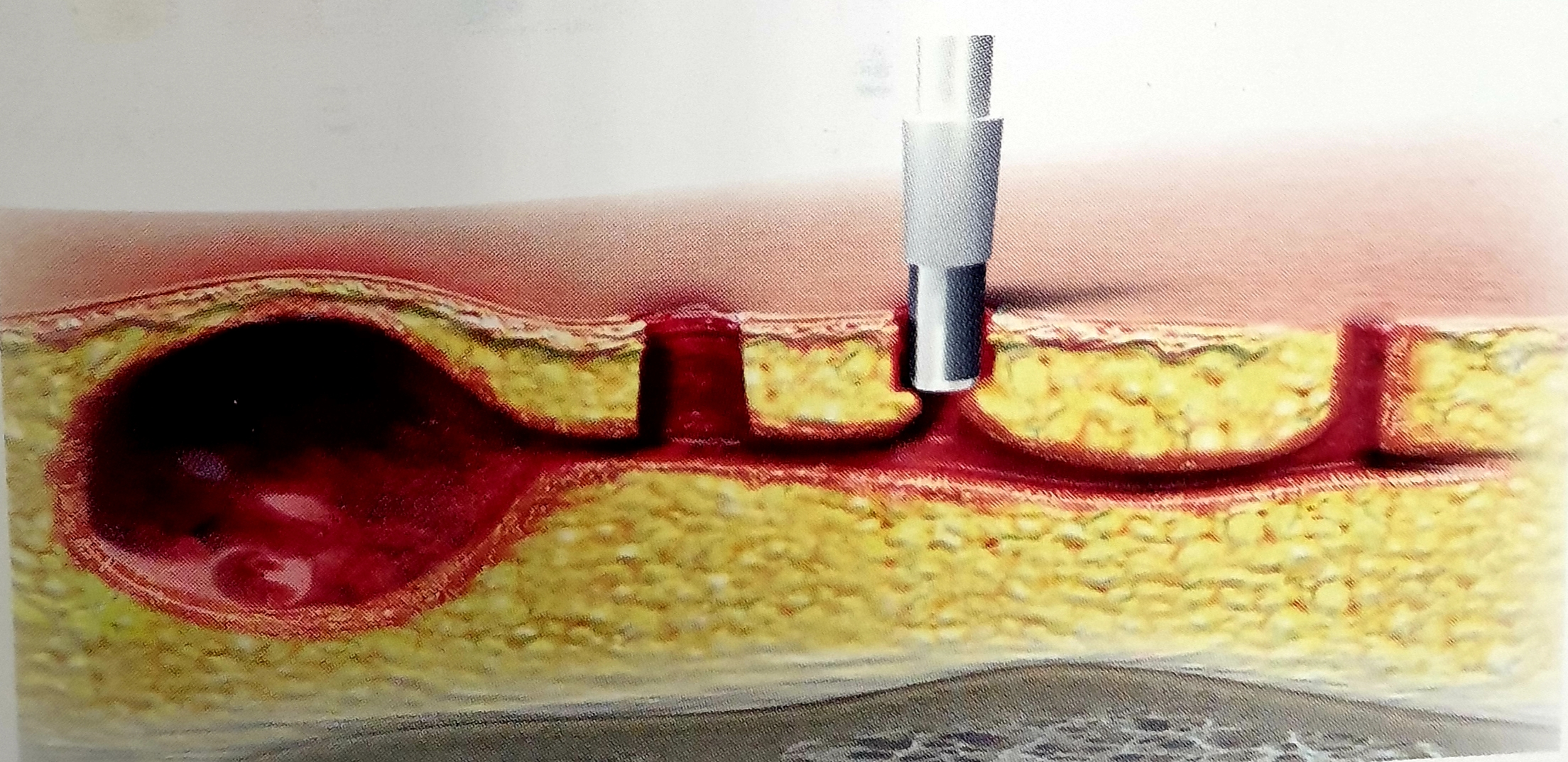 Κύστη κόκκυγα. Νέα, σύγχρονη μέθοδος αντιμετώπισης ενδοσκοπικά-μέθοδος EPSiT ή με χρήση Laser-μέθοδος FILAC, ανώδυνα, αναίμακτα. 1 EPSiT ενδοσκοπική αντιμετώπιση κύστης κόκκυγα