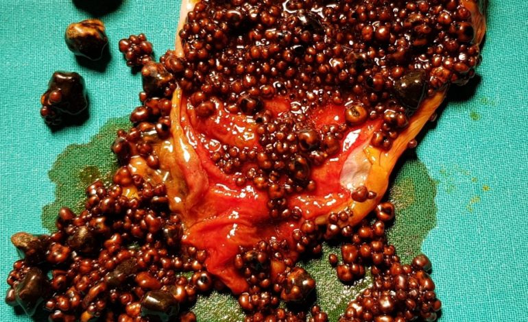 πολλαπλή χολολιθίαση - μικρολιθίαση