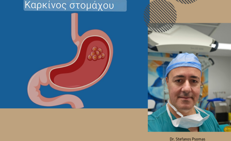 Καρκίνος του στομάχου. Αίτια, διάγνωση και θεραπεία 17 Καρκίνος του στομάχου