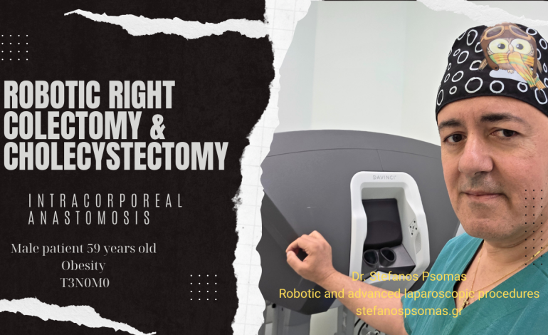 ΡΟΜΠΟΤΙΚΗ CME ΔΕΞΙΑ ΚΟΛΕΚΤΟΜΗ & ΧΟΛΟΚΥΣΤΕΚΤΟΜΗ ΓΙΑ ΑΔΕΝΟΚΑΡΚΙΝΩΜΑ ΤΟΥ ΕΓΓΥΣ ΕΓΚΑΡΣΙΟΥ ΚΟΛΟΥ ΚΑΙ ΧΟΛΟΛΙΘΙΑΣΗ. ΕΝΔΟΣΩΜΑΤΙΚΗ ΑΝΑΣΤΟΜΩΣΗ. 13 1000026003