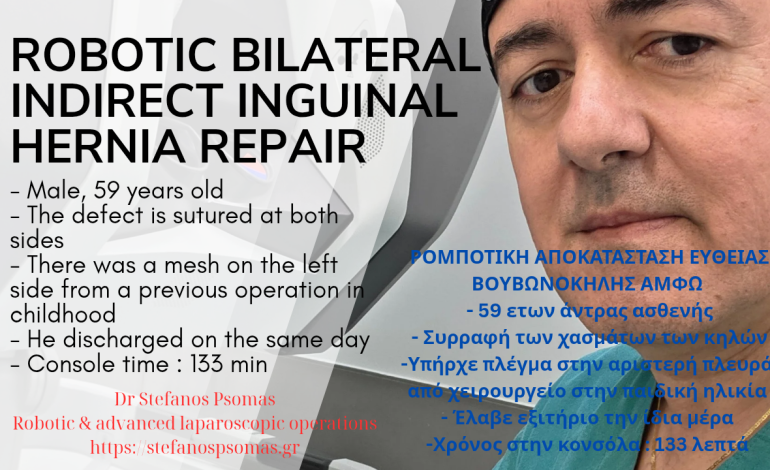 ΡΟΜΠΟΤΙΚΗ ΑΠΟΚΑΤΑΣΤΑΣΗ ΑΜΦΟΤΕΡΟΠΛΕΥΡΗΣ ΕΥΘΕΙΑΣ ΒΟΥΒΩΝΟΚΗΛΗΣ ΜΕ ΣΥΡΡΑΦΗ ΤΩΝ ΧΑΣΜΑΤΩΝ 15 ROBOTIC bilateral indirect inguinal hernia repair 20250623 212209 0000