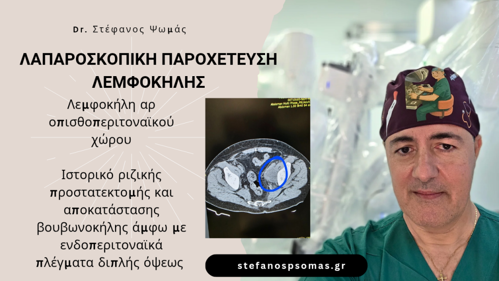 Laparoscopic drainage of lemphocele 20250806 215215 0000