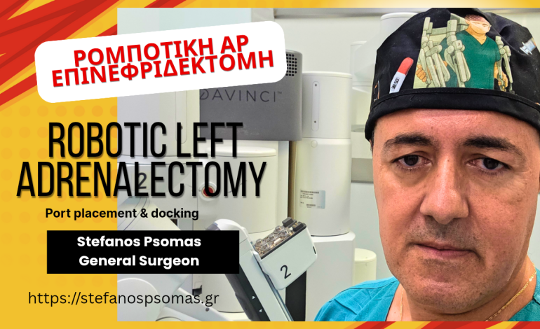 Ρομποτική επινεφριδεκτομή 6 Shocking moments 20250914 102609 0000
